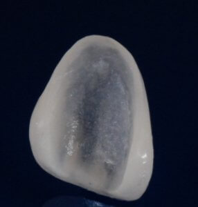 veneers smile transformation