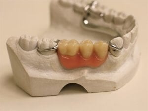 Dentures: A Complete Guide to False Teeth Options and Costs
