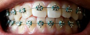 metal braces vs invisalign