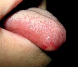 Herpes on Tongue