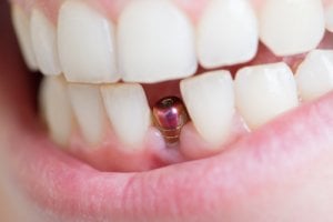 front tooth implant cost