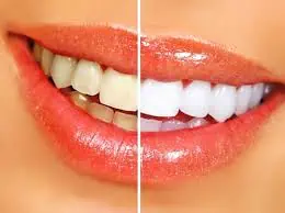 teeth whitening