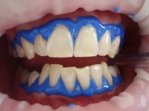dental whitening process