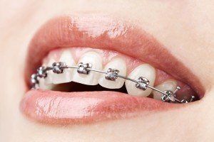 dental insurance braces texas