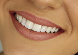 veneers cost