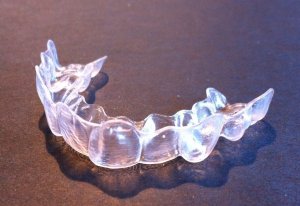 alternativa più economica a Invisalign