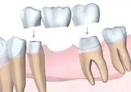 Dental bridge 