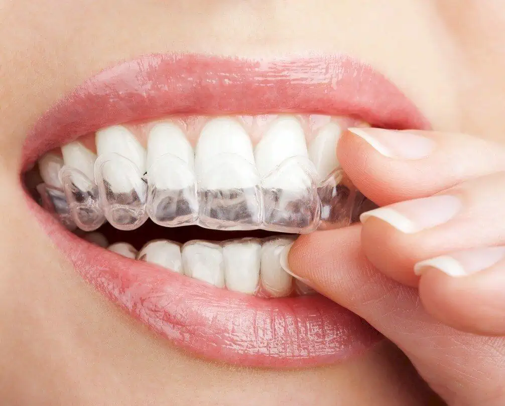 Ceramic Braces What Do They Cost and Should You Get Them?