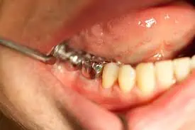 back teeth crowns