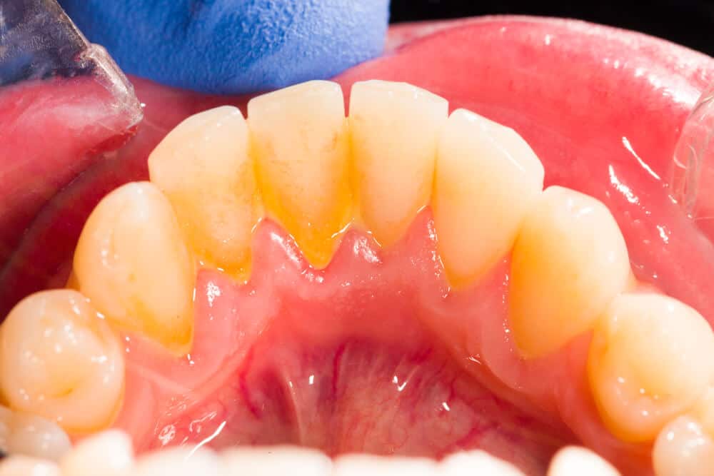What is a Cavity? Tooth Decay Symptoms, Causes & Treatments