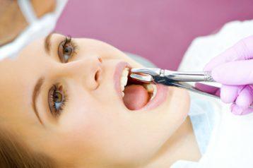 Dos and Don'ts After Tooth Extraction: Post-Op Instructions