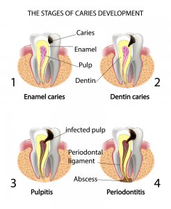 Tooth abscess stages