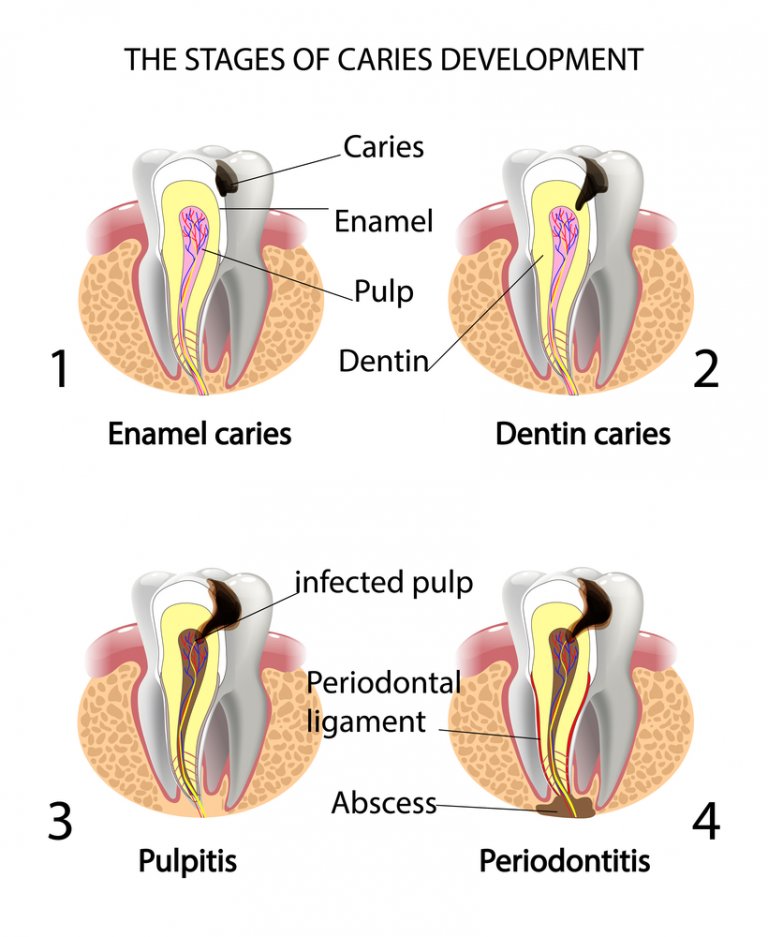 Tooth Abscess Guide Dental Infection Symptoms and Treatment