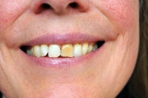abscesované příznaky zubů