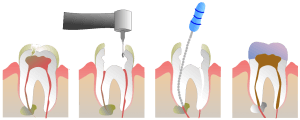 cheap tooth extraction no insurance
