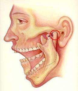 Damage to temporo-mandibular joint caused by bruxism