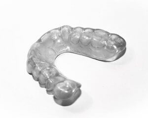 Custom full mouth guard for bruxism 