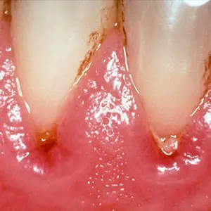 gum disease