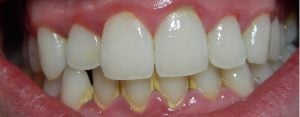 image of dental plaque buildup on teeth