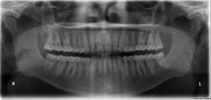 image of an x-ray of the jaw