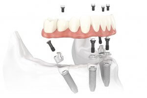 teeth implants cancun