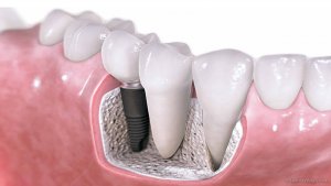 diagram of tooth implant