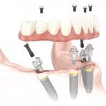 Full dental implants
