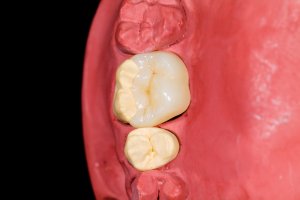 onlay to repair tooth