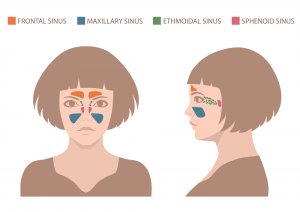 Sinus diagram to show where dental implant surgery may become complicated. 