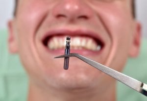 cheaper dental implants