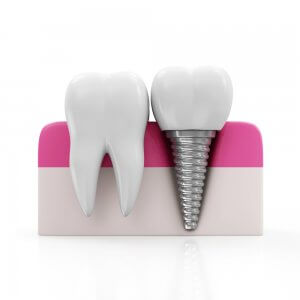 Dental Implants in Spain