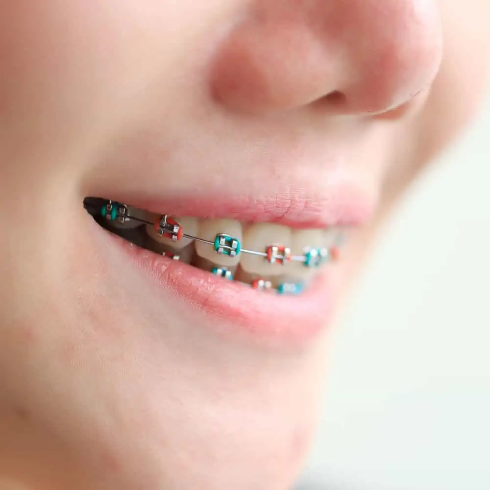 Braces Colors How to Pick the Best Ones for You