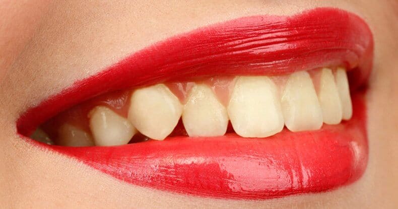 fotor teeth whitening