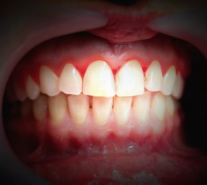 red bleeding gums