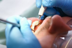 dental scaling