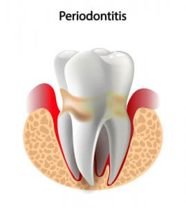 periodontitis inflamed gum around tooth