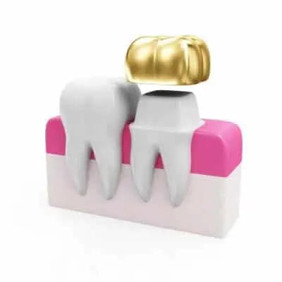 dental crown