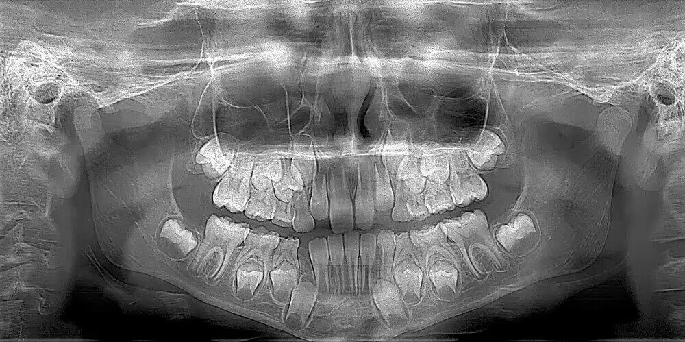 Panoramic Dental XRay Costs, Procedure and More