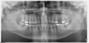 panoramic teeth x ray