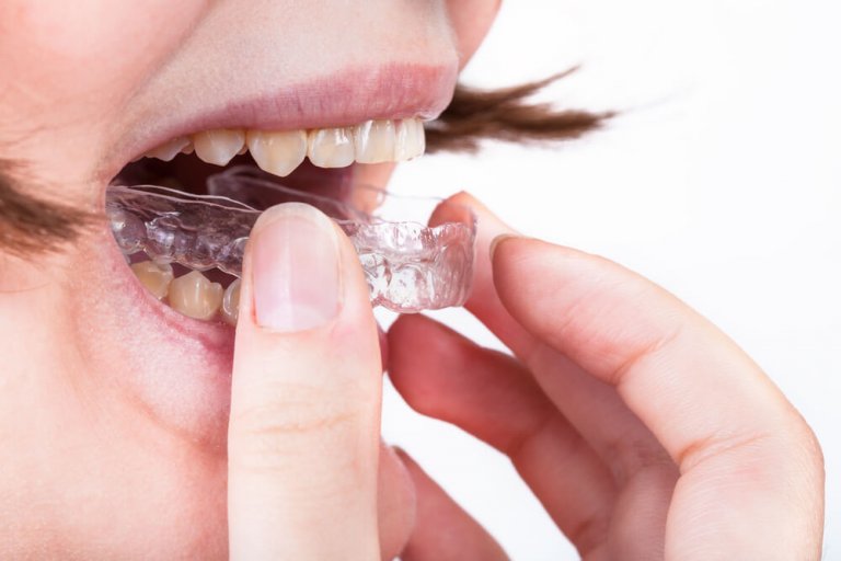 Essix Retainer Cost, Cleaning, Care and Pros and Cons