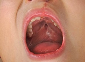 cleft palate picture