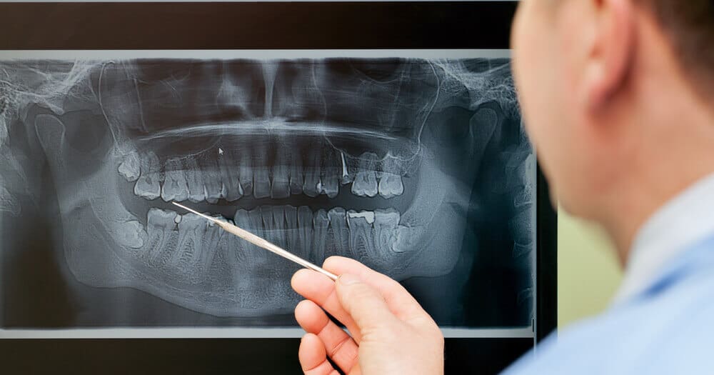 Panoramic Dental XRay Why Get One, Costs, and Procedure