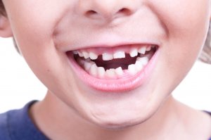 child with crooked teeth