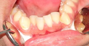 crowded lower teeth