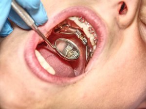 palate expander