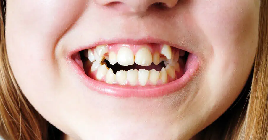 girl with open bite teeth