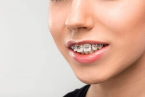 overbite teeth with braces