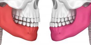 overbite vs underbite