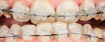 Close-up of teeth with metal braces, showing clear brackets and metal wires, highlighting orthodontic treatment.