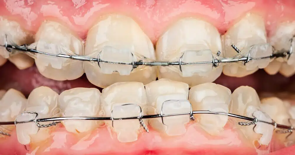 Close-up of teeth with metal braces, showing clear brackets and metal wires, highlighting orthodontic treatment.
